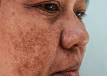 Tìm hiểu về nám da và cách khắc phục