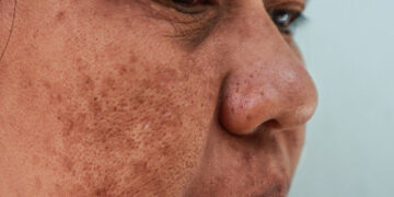 Tìm hiểu về nám da và cách khắc phục