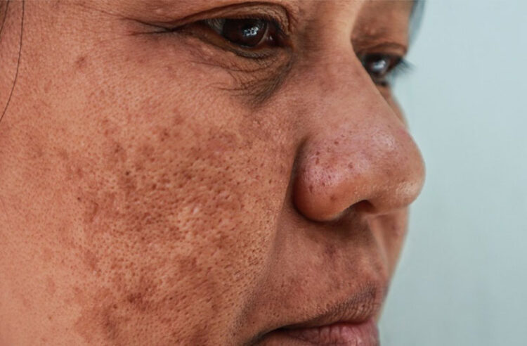 Tìm hiểu về nám da và cách khắc phục