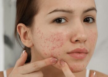 Top 10 spa trị mụn ở TPHCM: an toàn hiệu quả và chất lượng 2024