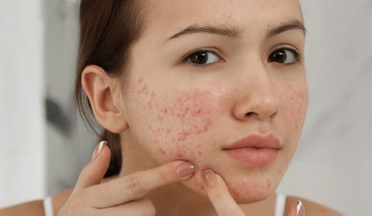 Top 10 spa trị mụn ở TPHCM: an toàn hiệu quả và chất lượng 2024