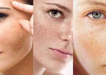 Làm Thế Nào Để Chọn Spa Phù Hợp Cho Điều Trị Nám?