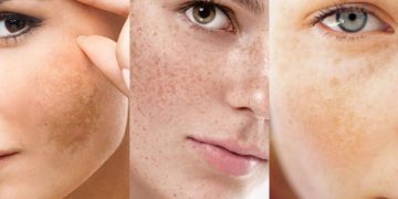 Làm Thế Nào Để Chọn Spa Phù Hợp Cho Điều Trị Nám?