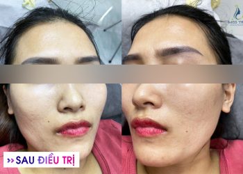 Giải Pháp Điều Trị Mụn An Toàn Ở Quận 3: Cách Lấy Lại Làn Da Khỏe Mạnh