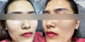 Giải Pháp Điều Trị Mụn An Toàn Ở Quận 3: Cách Lấy Lại Làn Da Khỏe Mạnh