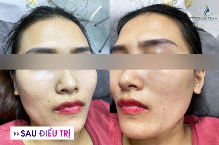 Giải Pháp Điều Trị Mụn An Toàn Ở Quận 3: Cách Lấy Lại Làn Da Khỏe Mạnh