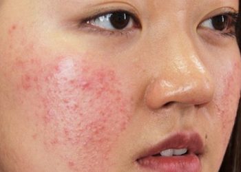 Điều Trị Mụn Trứng Cá: Bật Mí Phương Pháp An Toàn, Hiệu Quả Theo Chuẩn Y Khoa