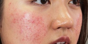 Điều Trị Mụn Trứng Cá: Bật Mí Phương Pháp An Toàn, Hiệu Quả Theo Chuẩn Y Khoa