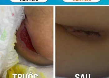 Tìm Hiểu Kentori Hygiene Care (HOCL) Giúp Lành Thương Ra Sao?