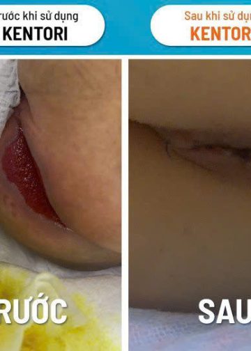 Tìm Hiểu Kentori Hygiene Care (HOCL) Giúp Lành Thương Ra Sao?